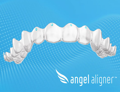 Angel Aligner Upgrades Torque Ridges to New &ldquo;Pressure Points&rdquo; in Europe