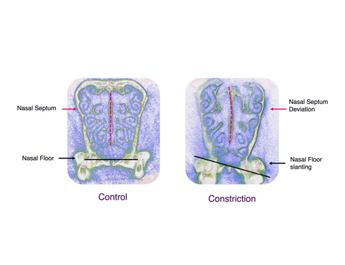 Groundbreaking Research by CTOR Explores the Connection Between Bite, Facial Growth and Breathing
