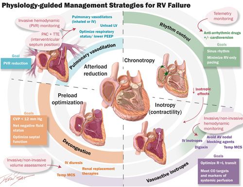 New HFSA Scientific Statement Calls for Recognition of Right Heart Failure as a Distinct Clinical Syndrome