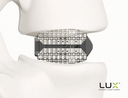 GIF Animation of the Lux Expandable Interbody Fusion Device