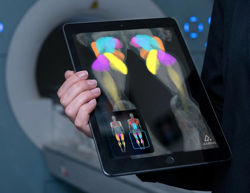 New Study Published in Neurology Expands Evidence for Using MRI Biomarkers in SBMA by Measuring Muscles with Quantitative MRI