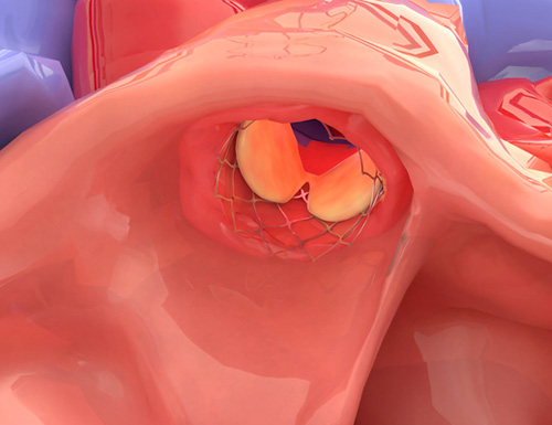 GrOwnValve Achieves Primary Safety Endpoint in First-in-Human Heart Valve Study