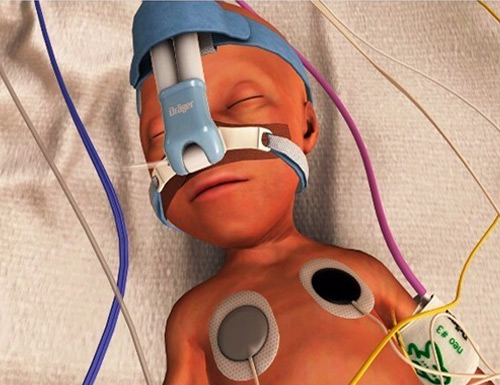 Dräger and VirtualiSurg Win Obsidian Award for Babyleo XR Extended Reality Simulator