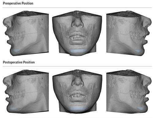 Dr. David Salehani, Top Oral and Maxillofacial Surgeon in Los Angeles, Enhances Genioplasty and Corrective Jaw Surgery with Virtual Surgical Planning