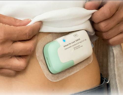 SQ Innovation Announces FDA Approval of Lasix® ONYU for Heart Failure Edema Treatment
