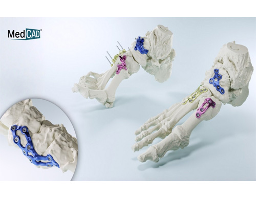 MedCAD’s AccuStride™ 