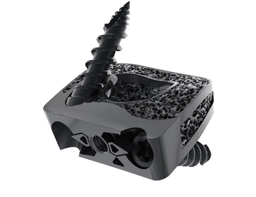 Spineart Announces Full U.S. Market Launch of SCARLET® AC-Ti Secured Anterior Cervical Cage
