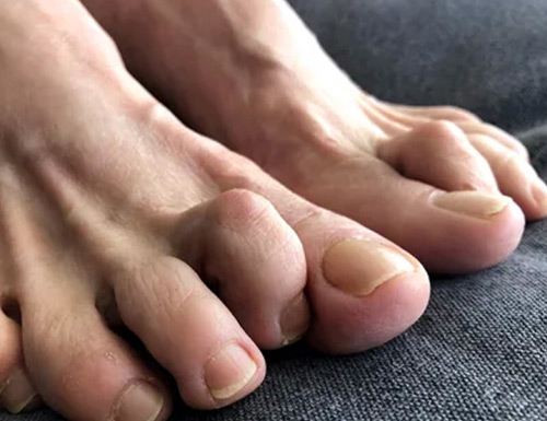 8 Top Secret Toe Problem Fixes Most Recommended by Podiatrists to Relieve Pain