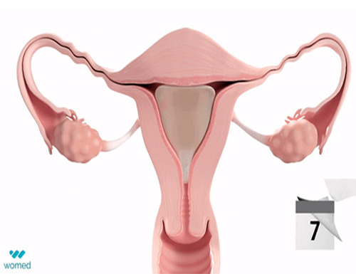 Female Fertility Preserving Device Launches in Europe by Womed