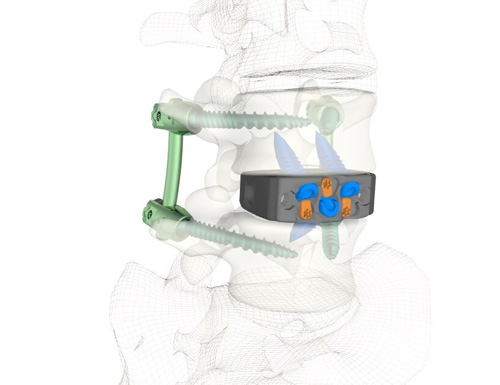 Varisync ALIF Construct with NanoPrime Cage 